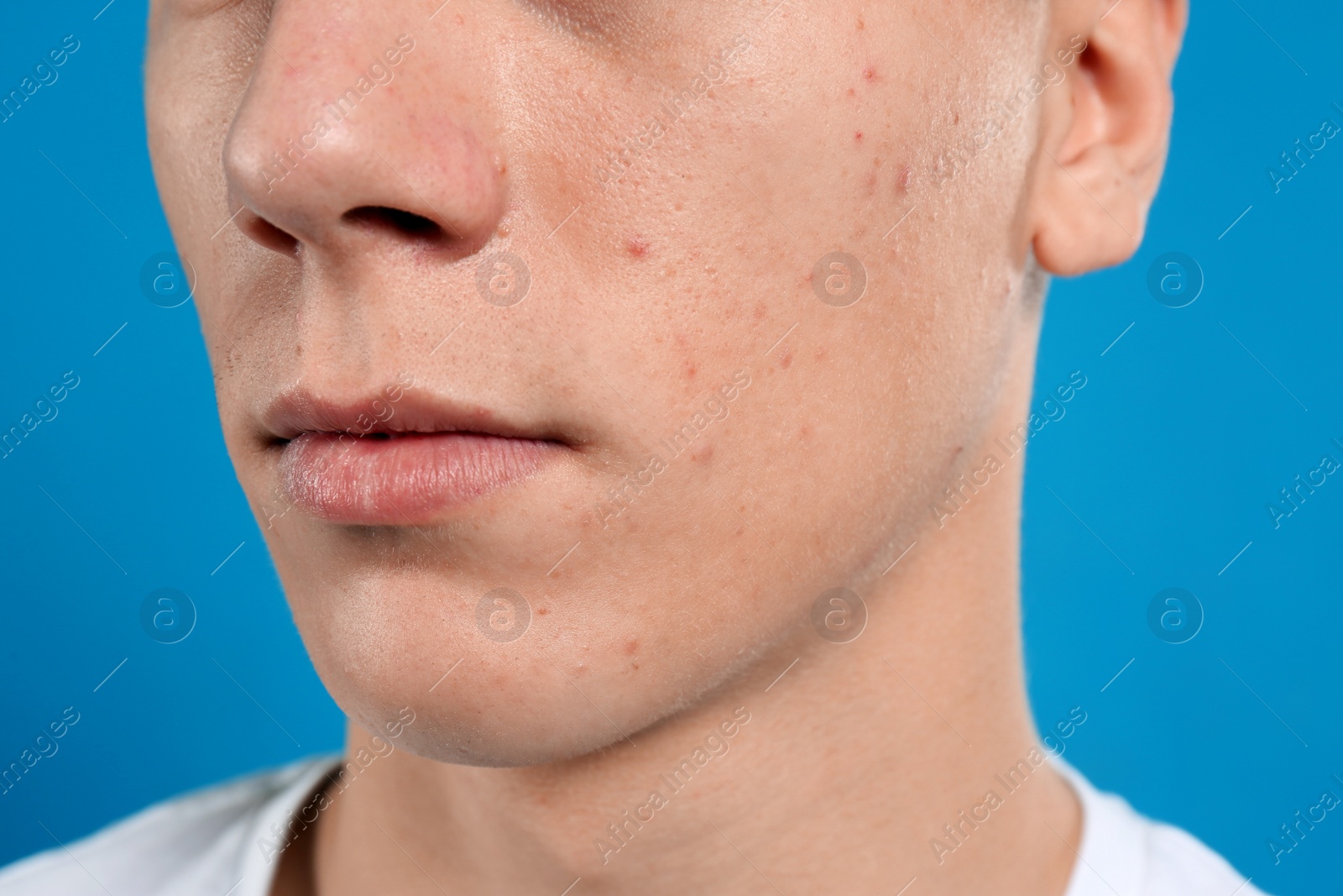 Photo of Teen guy with acne problem on blue background, closeup