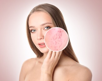 Woman with acne on her face on beige gradient background. Zoomed area showing problem skin