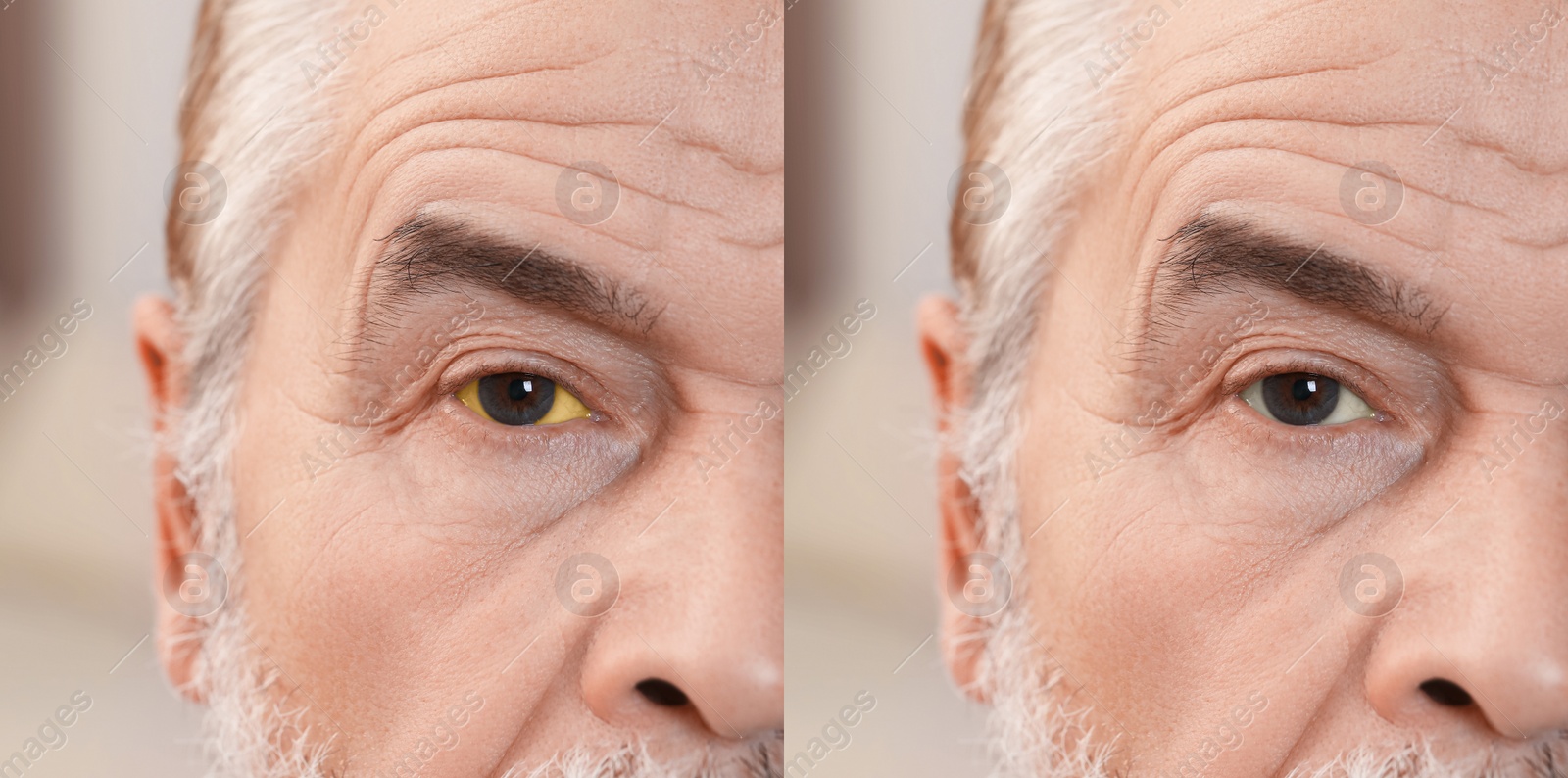 Image of Collage with photos of senior man before and after hepatitis treatment, focus on eyes. Banner design
