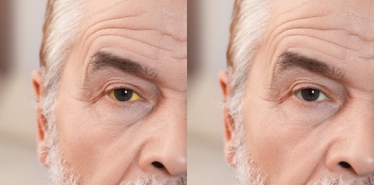 Image of Collage with photos of senior man before and after hepatitis treatment, focus on eyes. Banner design