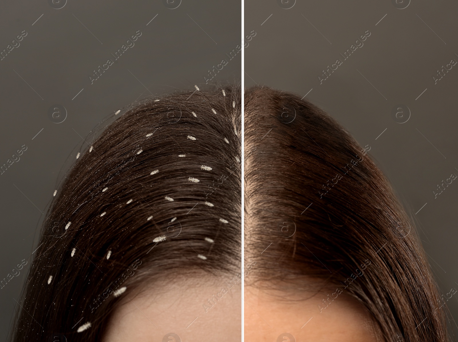 Image of Collage showing woman's hair before and after lice treatment on grey background, closeup. Suffering from pediculosis