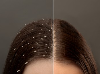 Collage showing woman's hair before and after lice treatment on grey background, closeup. Suffering from pediculosis