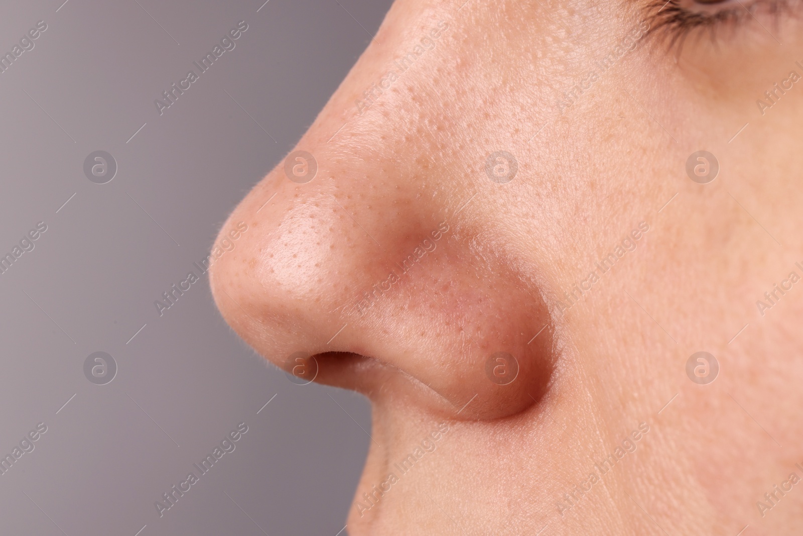 Photo of Young woman with acne problem on grey background, closeup