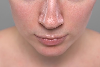 Photo of Closeup view of woman with reddened skin on grey background