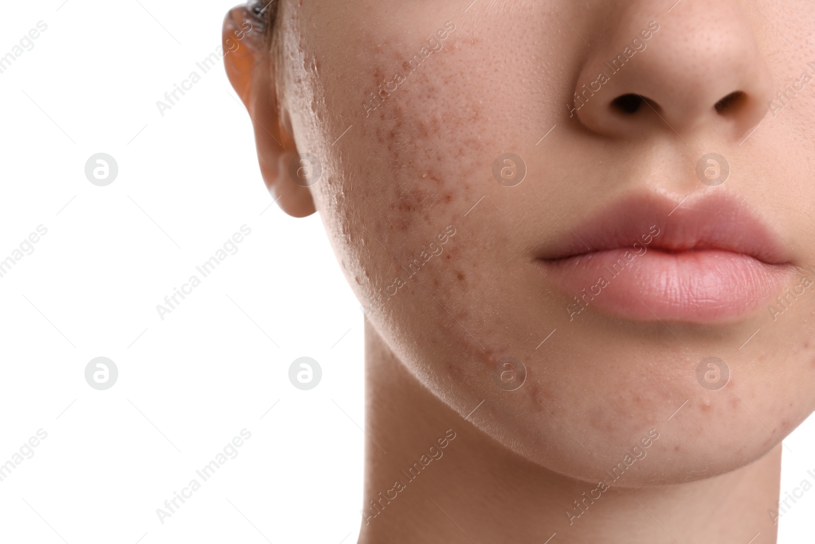 Photo of Teenage girl with acne problem on white background, closeup