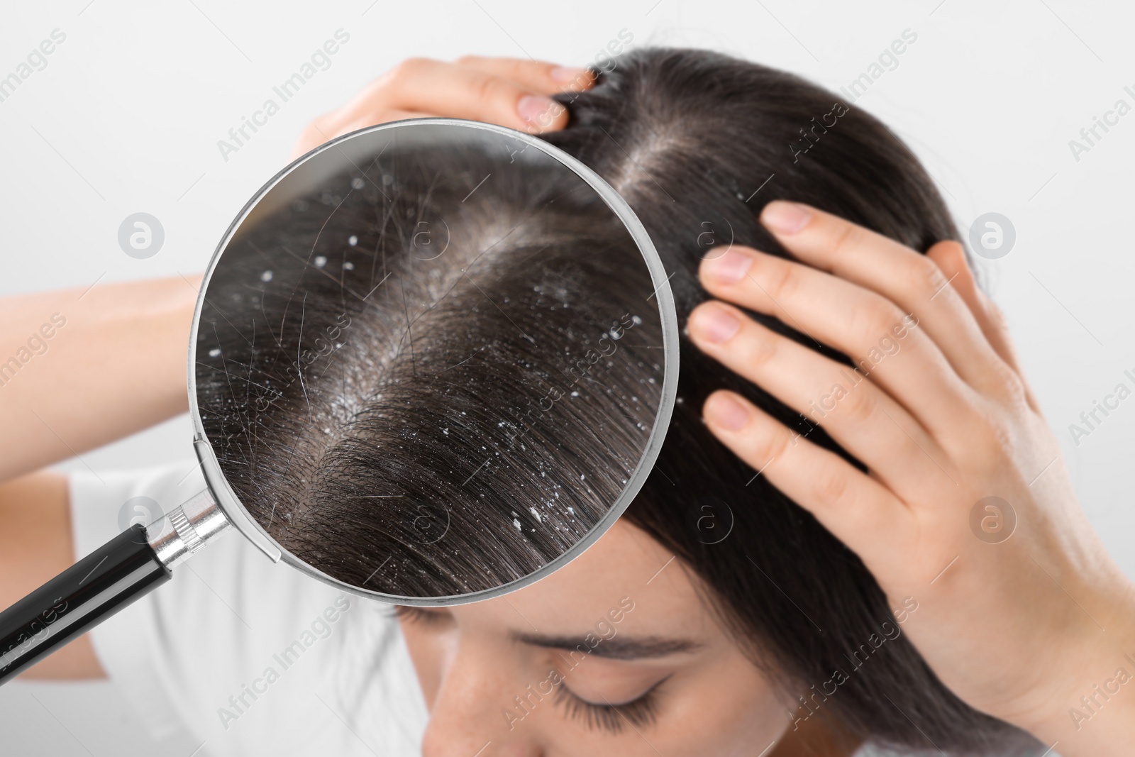 Image of Woman suffering from dandruff on light background, closeup. View through magnifying glass on hair with flakes