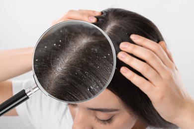 Woman suffering from dandruff on light background, closeup. View through magnifying glass on hair with flakes