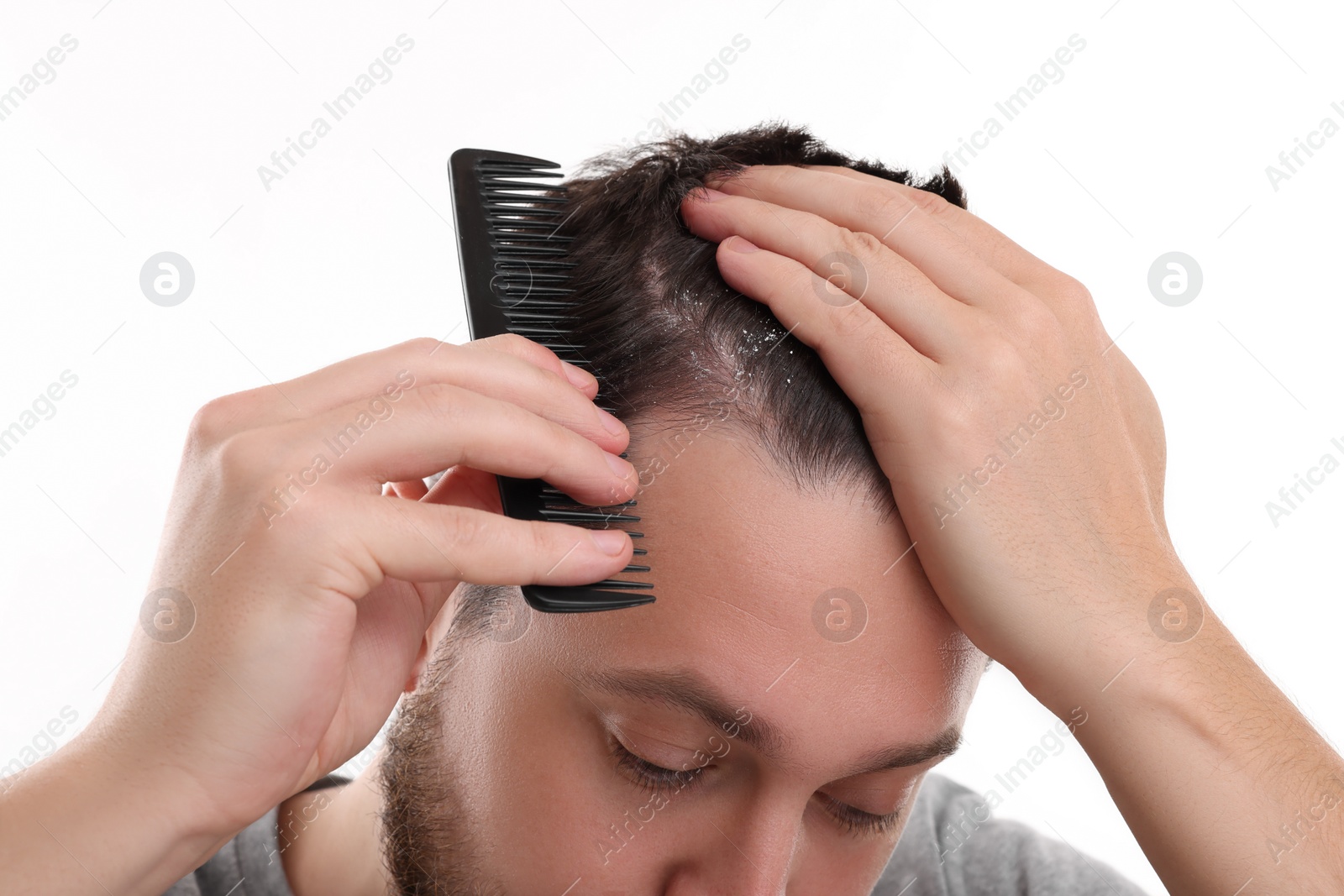 Photo of Dandruff problem. Man with comb examining his hair and scalp on white background, closeup