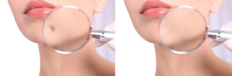 Image of Collage with photos of patient's face before and after mole removing procedure, closeup. Dermatologist looking at skin through magnifying glass