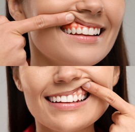 Image of Woman showing gum before and after treatment, collage of photos