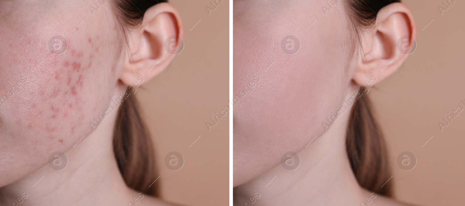 Image of Acne problem. Young woman before and after treatment on beige background, closeup. Collage of photos