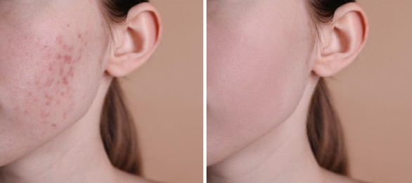 Image of Acne problem. Young woman before and after treatment on beige background, closeup. Collage of photos