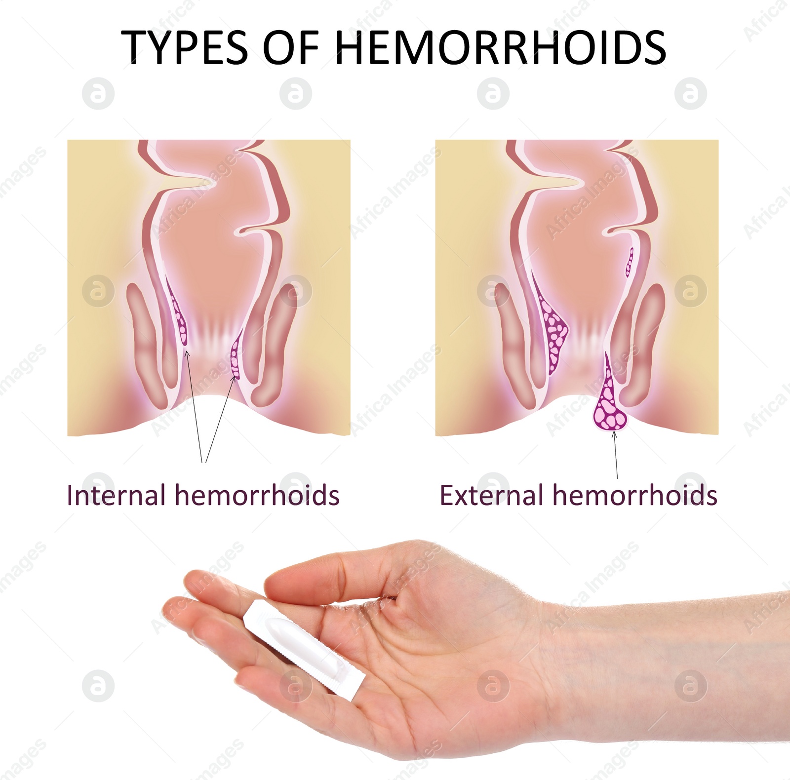 Image of Woman holding suppository for hemorrhoid treatment under illustrations of lower rectum on white background