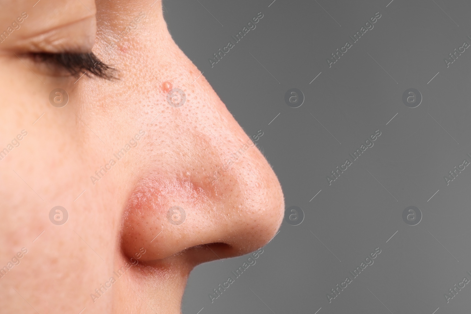 Photo of Young woman with acne problem on grey background, closeup. Space for text