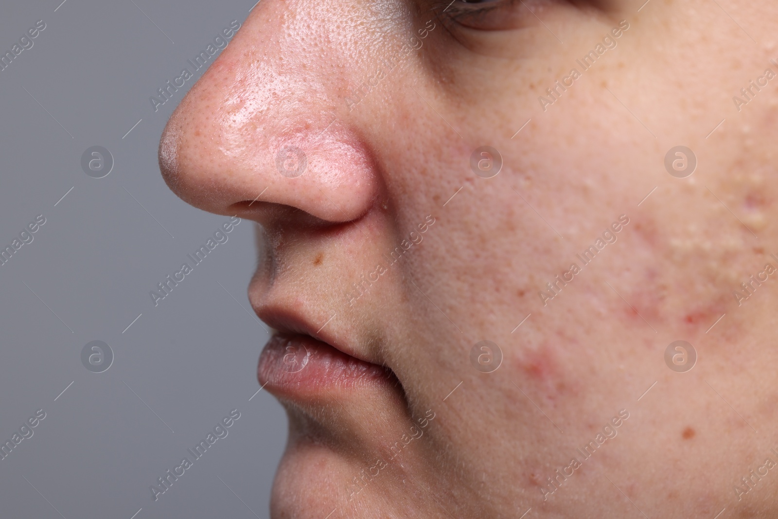 Photo of Closeup view of woman with unhealthy skin on grey background