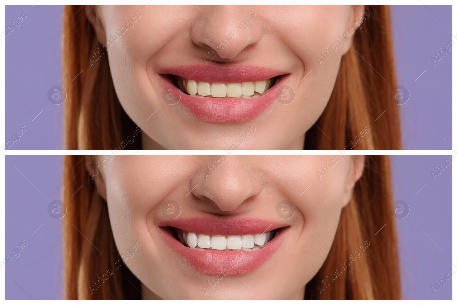 Image of Woman showing teeth before and after whitening on violet background, collage