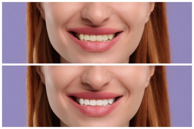 Image of Woman showing teeth before and after whitening on violet background, collage