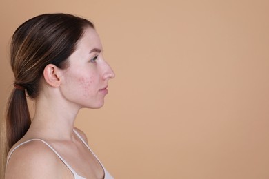 Photo of Young woman with acne problem on beige background. Space for text