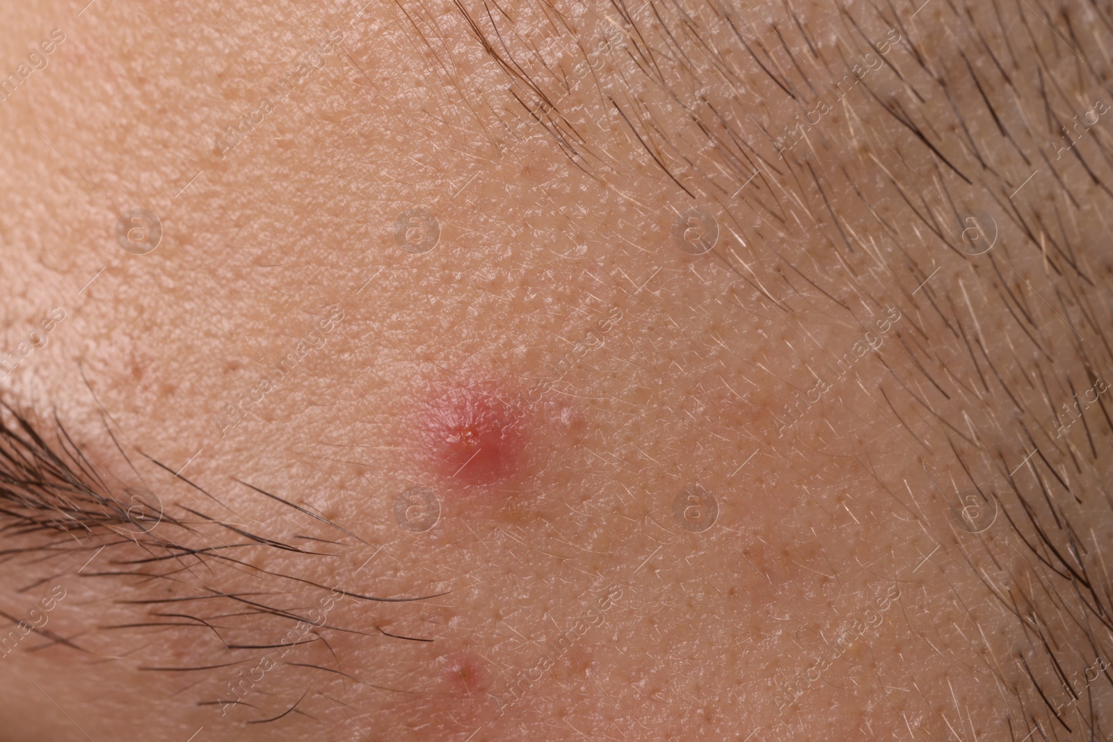 Photo of Young man with acne problem, closeup view