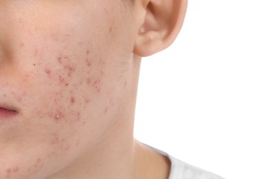 Photo of Young man with acne problem isolated on white, closeup