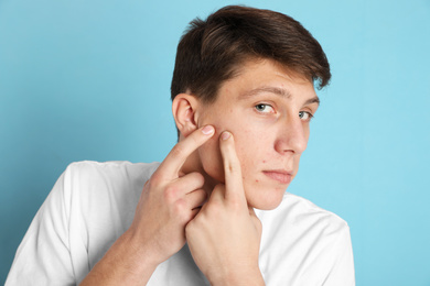 Photo of Teen guy with acne problem squeezing pimple on light blue background