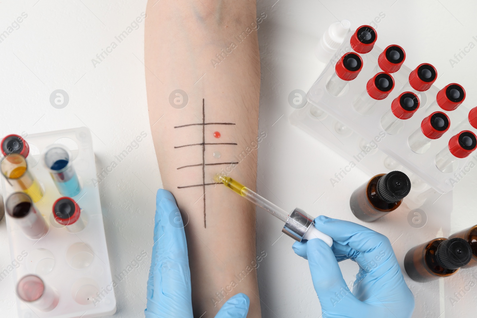 Photo of Doctor doing skin allergy test at light table, top view