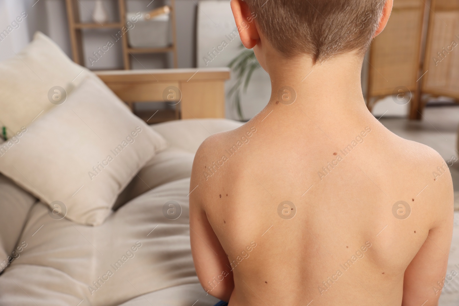 Photo of Closeup of boy's body with birthmarks in living room, back view. Space for text