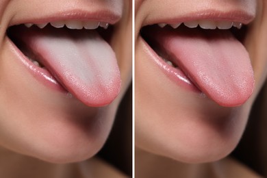 Woman showing her tongue before and after cleaning procedure, closeup. Tongue coated with plaque on one side and healthy on other, collage