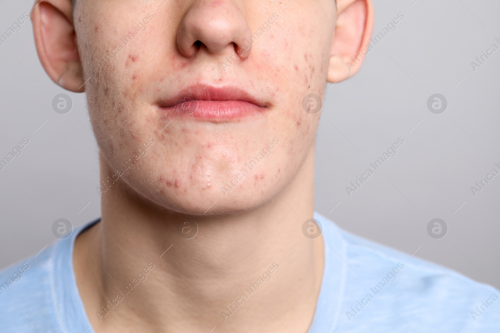 Photo of Young man with acne problem on grey background, closeup