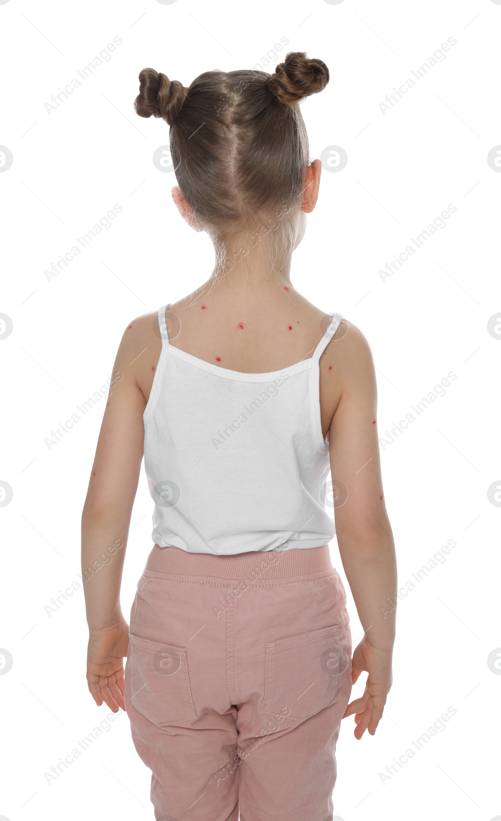 Photo of Little girl with chickenpox on white background. Varicella zoster virus