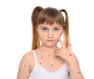 Photo of Little girl with chickenpox on white background