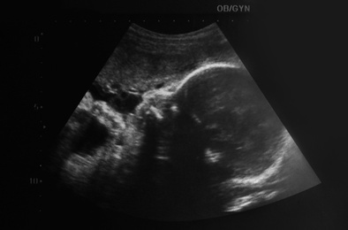 Ultrasound photo of unborn baby in mother's womb, closeup view