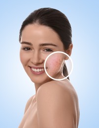 Woman with acne on her face on light blue background. Zoomed area showing problem skin