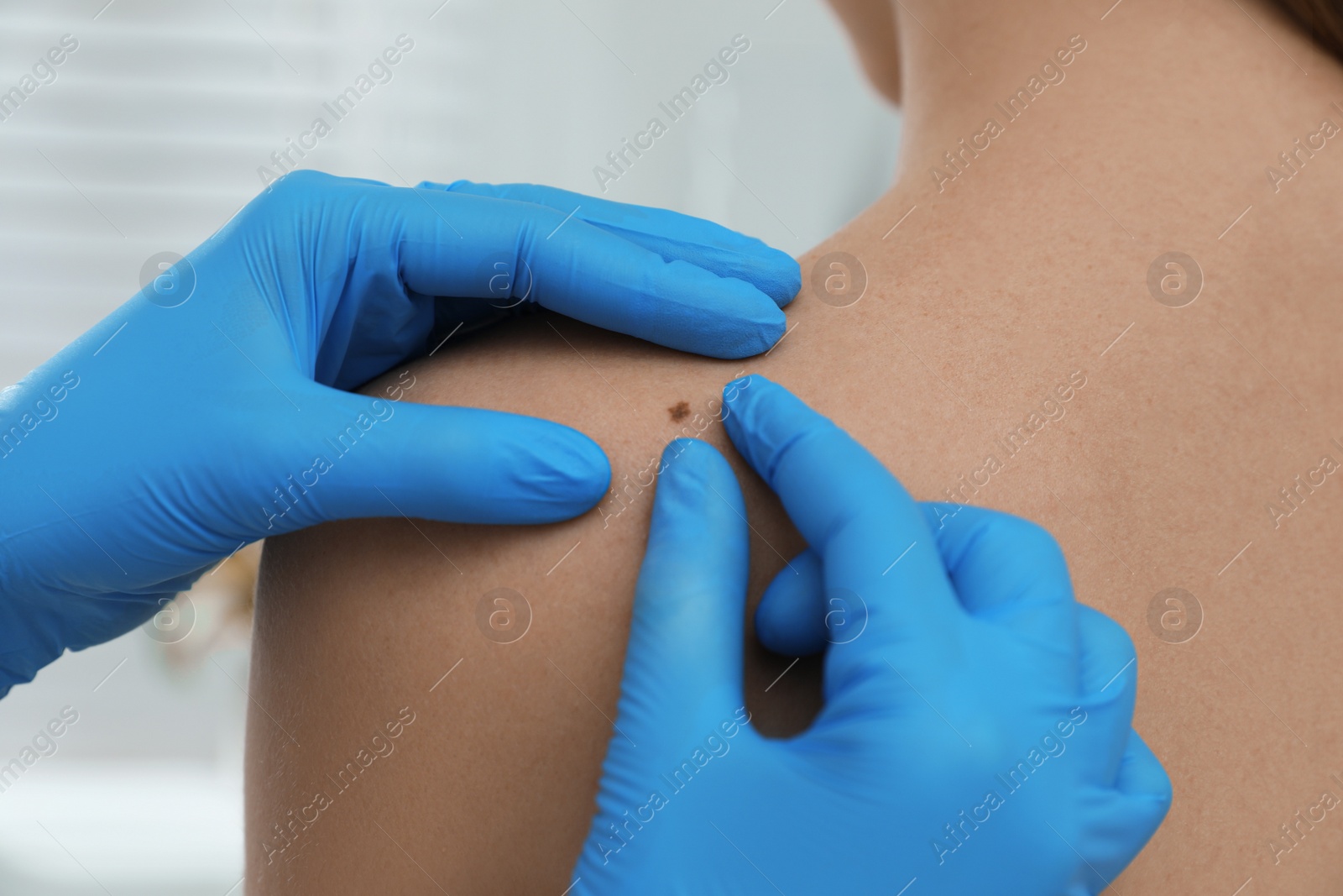 Photo of Dermatologist examining patient's birthmark in clinic, closeup view