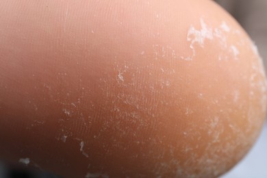 Photo of Woman with dry skin on foot, closeup