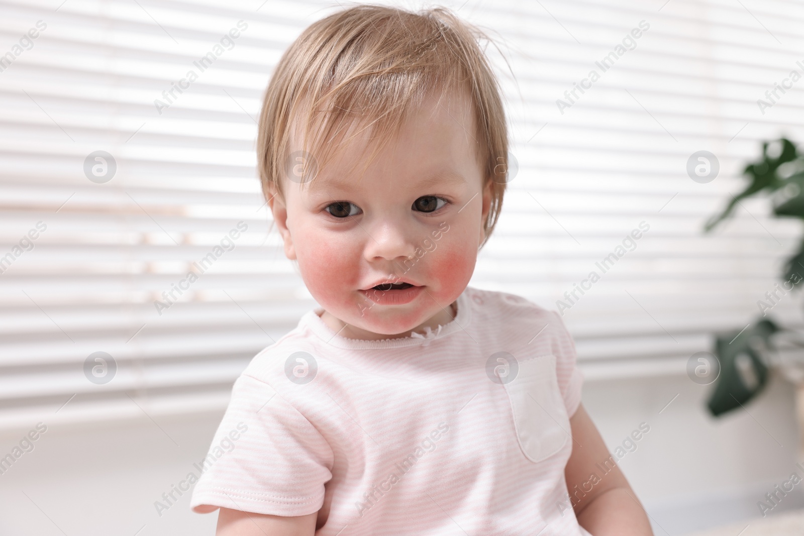 Photo of Portrait of little girl with diathesis symptom on cheeks indoors