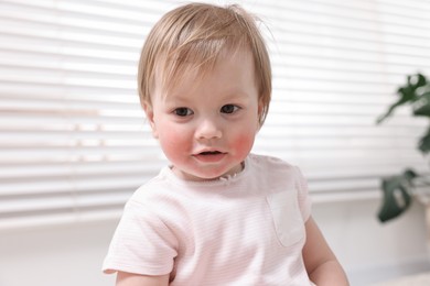 Portrait of little girl with diathesis symptom on cheeks indoors