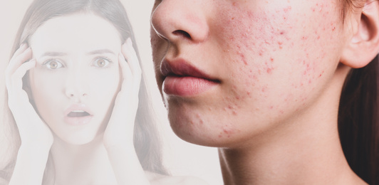 Image of Woman with acne problem, closeup. Vision of scared girl suffering from phobia