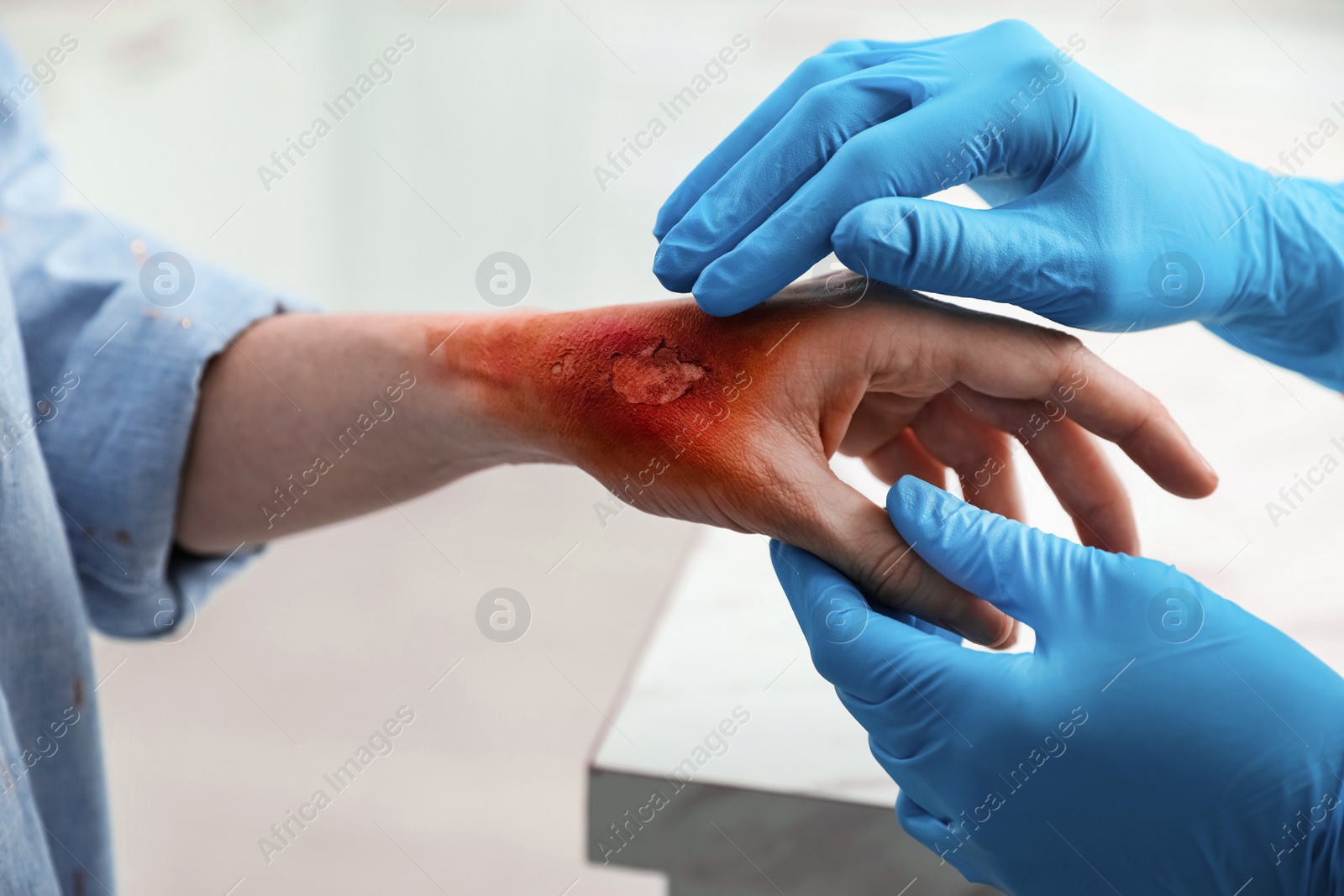 Photo of Doctor examining terrible patient's burn of hand indoors, closeup