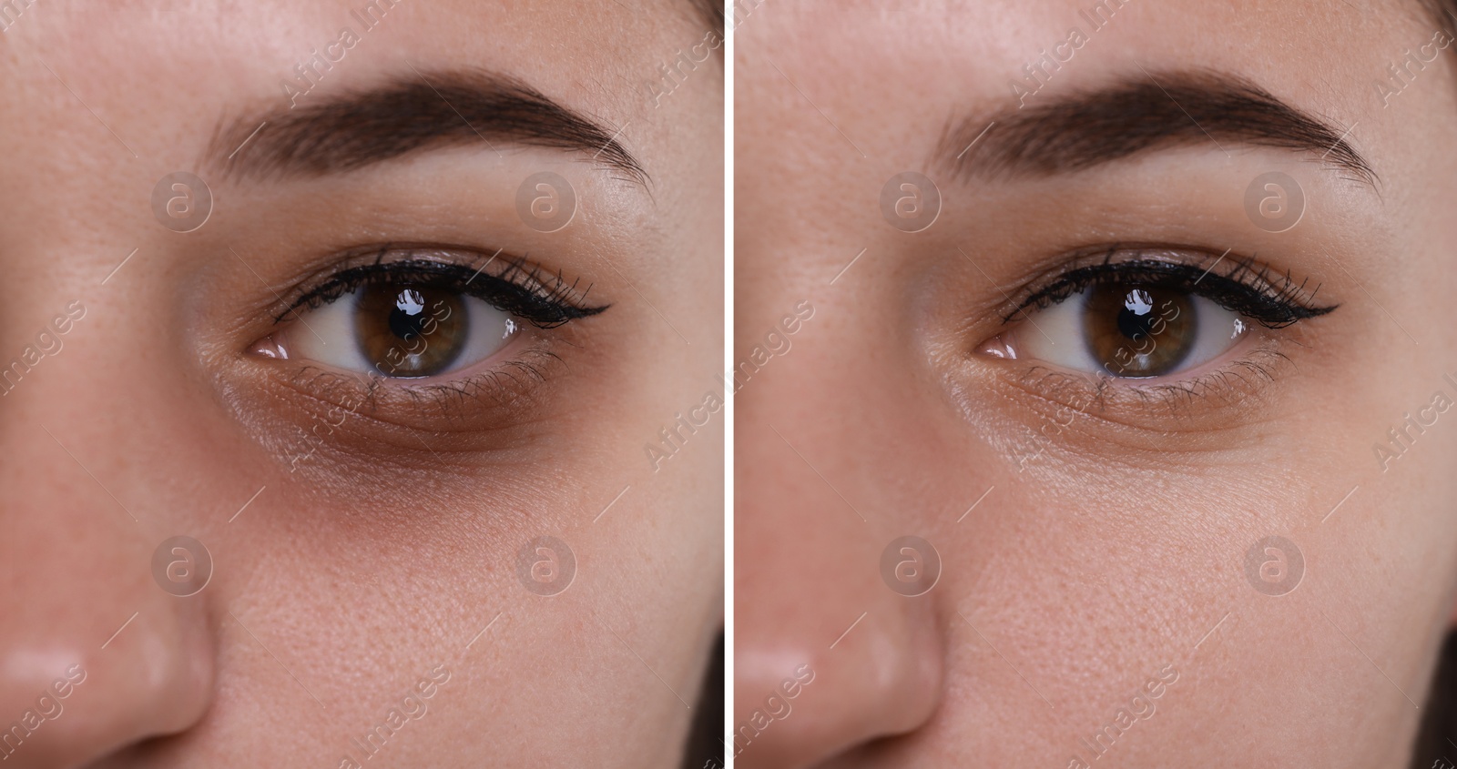 Image of Collage with photos of woman with dark circle under eye before and after treatment, closeup