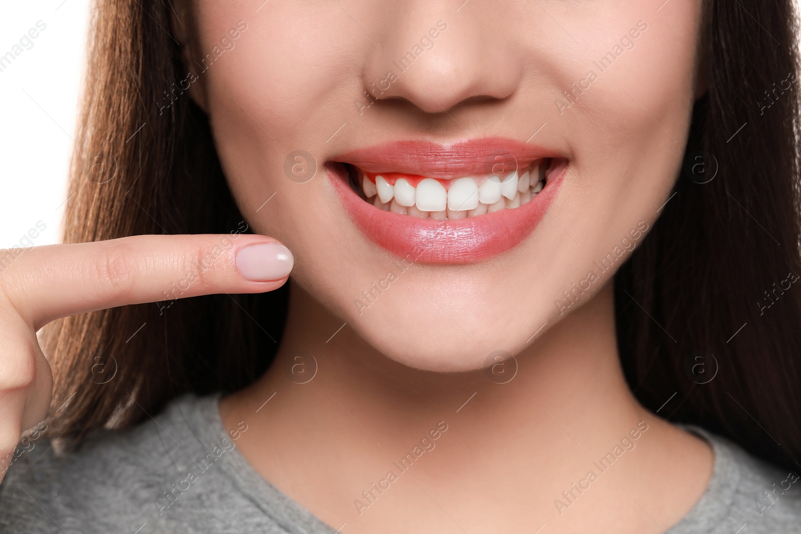 Image of Woman showing inflamed gum, closeup. Oral cavity health