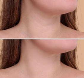 Aging skin changes. Woman showing neck before and after rejuvenation, closeup. Collage comparing skin condition