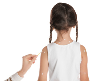 Mother applying cream onto skin of her daughter with chickenpox against white background