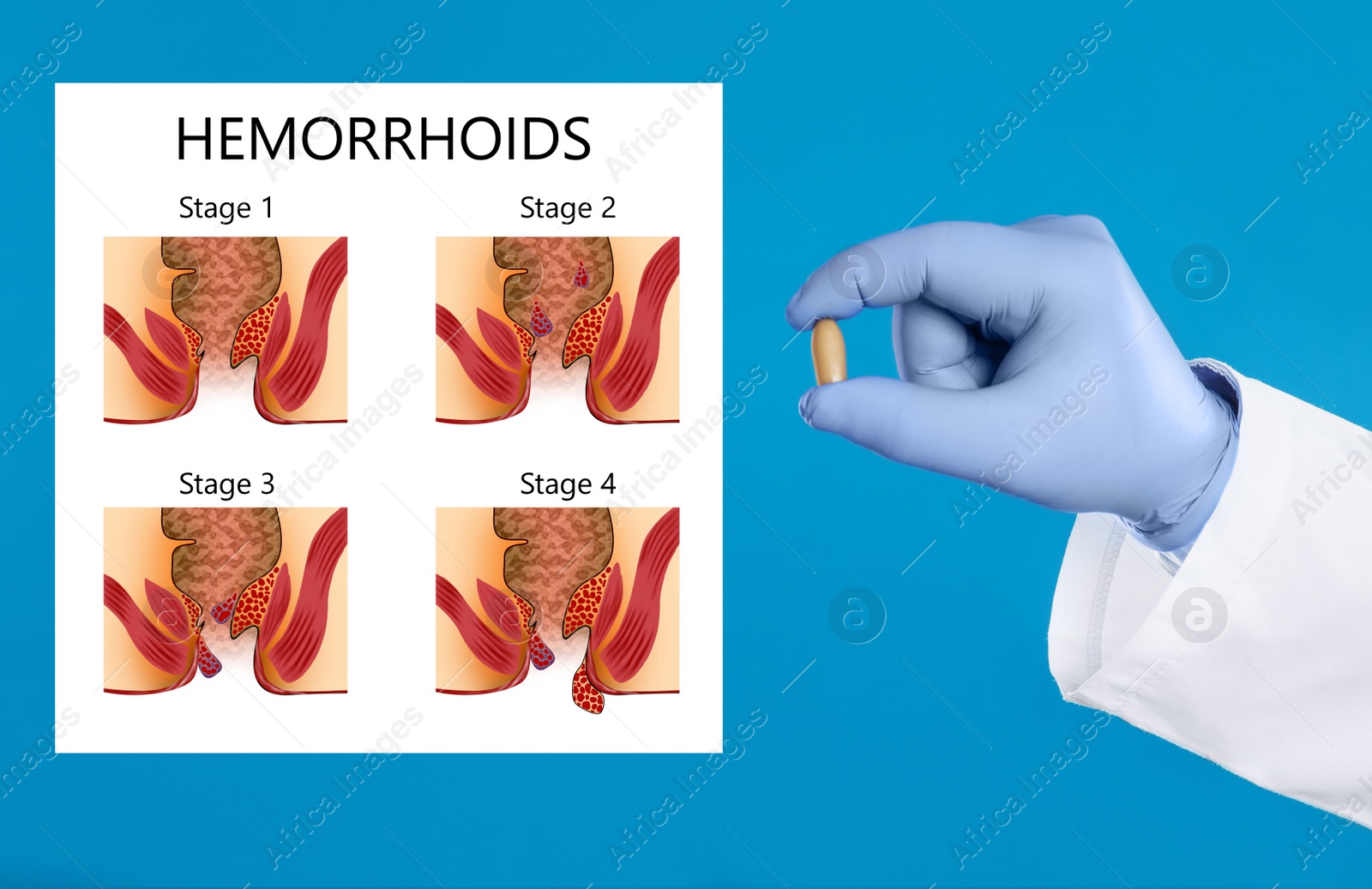 Image of Doctor holding suppository for hemorrhoid treatment near illustration of lower rectum progressing disease, blue background