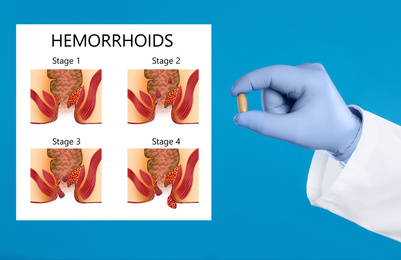 Doctor holding suppository for hemorrhoid treatment near illustration of lower rectum progressing disease, blue background