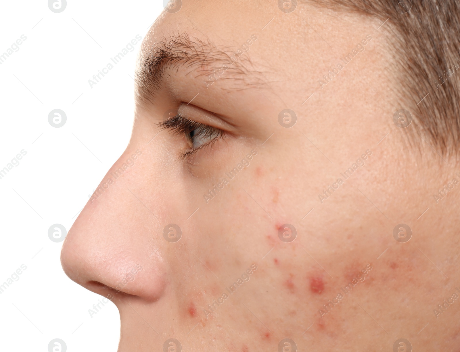 Photo of Teen guy with acne problem on white background, closeup