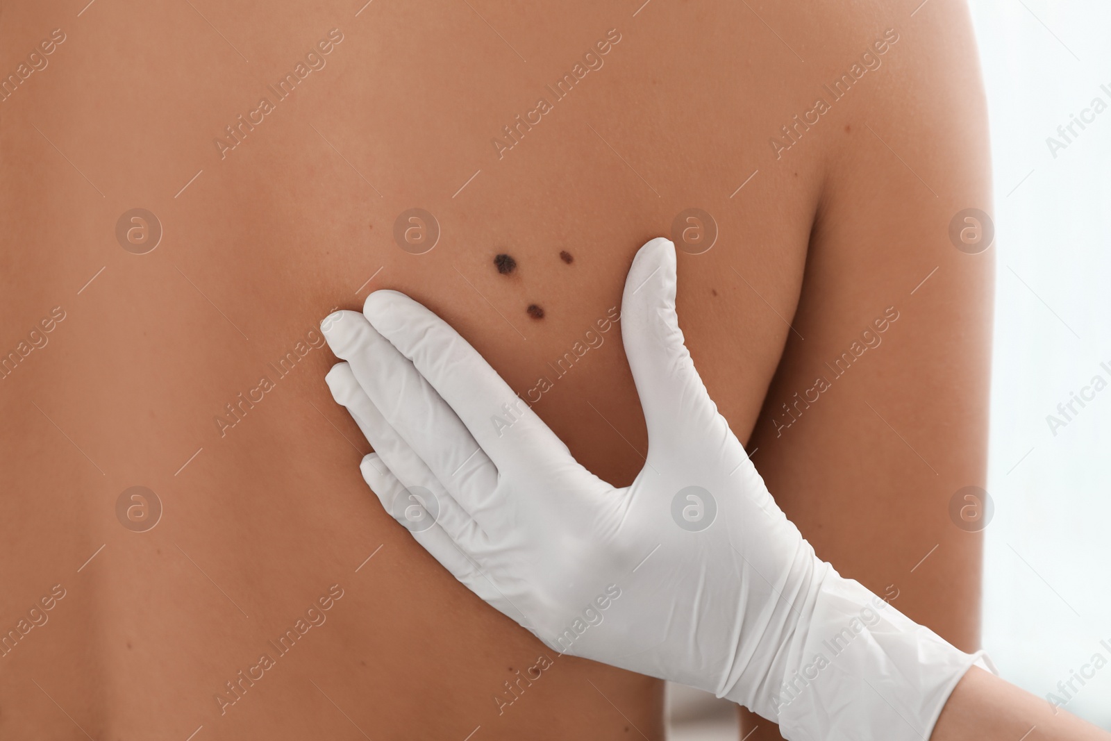 Photo of Dermatologist examining patient's birthmark in clinic, closeup