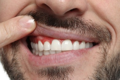 Image of Man showing inflamed gum, closeup. Oral cavity health