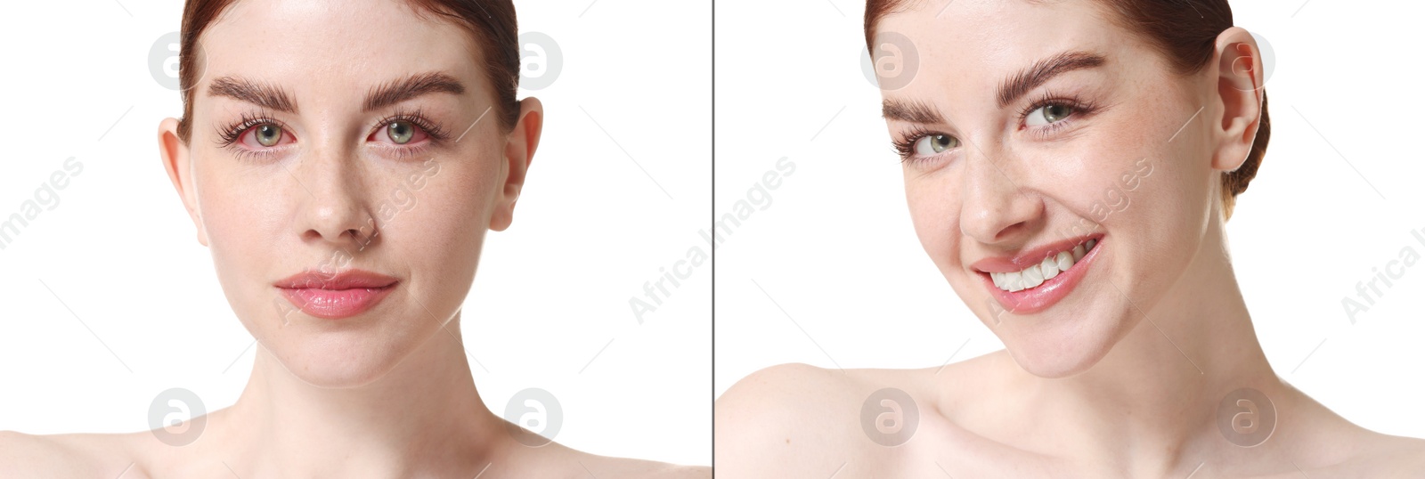 Image of Before and after conjunctivitis treatment. Photos of woman with red and healthy eyes, collage