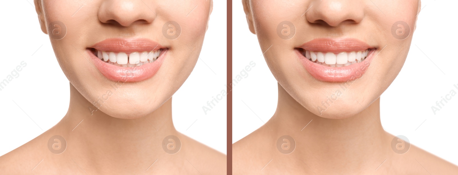 Image of Collage with photos of woman with diastema between upper front teeth before and after treatment on white background, closeup. Banner design